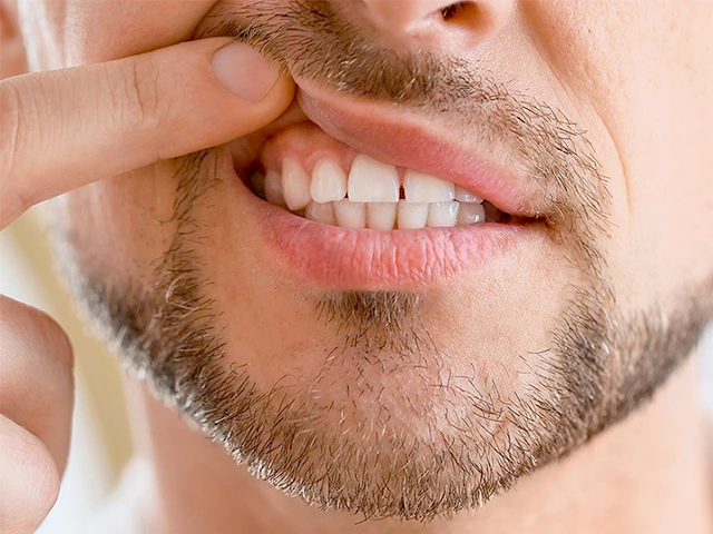 Eine Zahnfleischentzündung ist eine schmerzhafte Angelegenheit.