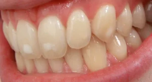 Auf dem Bild sieht man weiße Flecken auf den Zähnen.