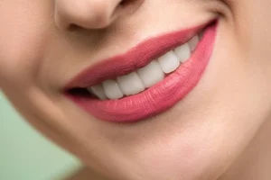 Das Bild zeigt eine Frau, die keine weißen Flecken auf den Zähnen hat.